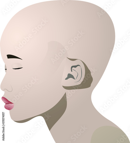 Concept girl with autoimmune disease, alopecia
