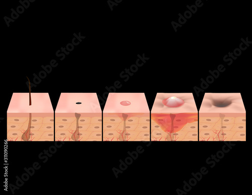 Treatment of open comedones, inflamed acne, acne cysts. Sore acne. structure of the skin. Treatment of scars of acne and pimples. blackheads. Infographics. Vector illustration