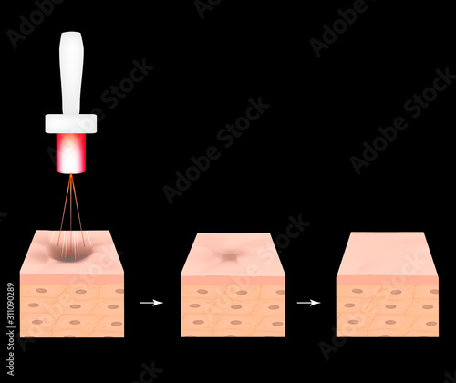 Acne scars. Laser scar atrophic treatment. The anatomical structure of the skin with acne. Vector illustration.