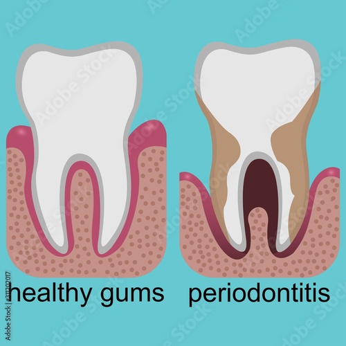 Difference between healthy gums and gums with periodontitis
