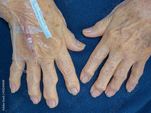 View of the hands in a mature female patient with osteoarthritis photo