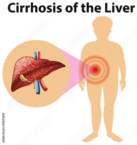 Diagram showing cirhosis of the liver
