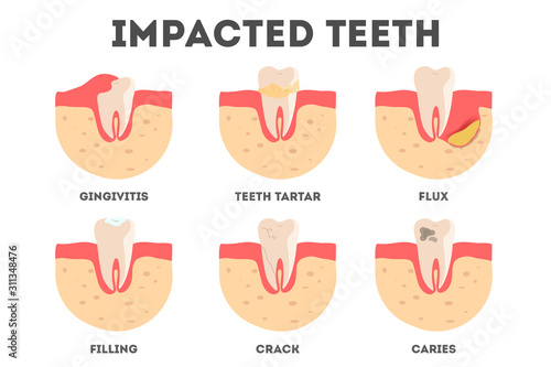 Set of diffrent impacts on human teeth. Dental and oral diseases.