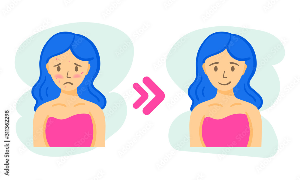 Acne before and after. Vector woman face. Skin care illustration Acne before and after. Vector woman face. Skin care illustration
