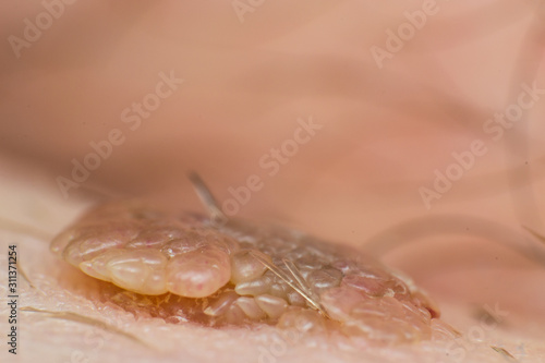 Macro photo of a skin wart, papilloma virus infection photo