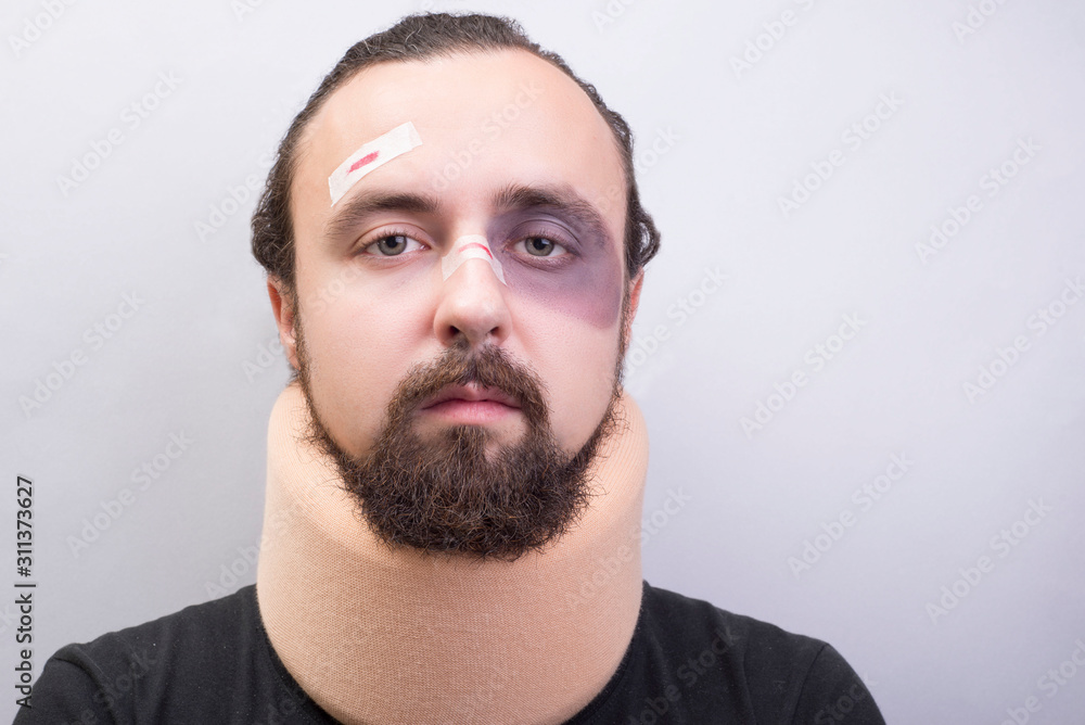 Obraz premium Closeup portrait of a young guy with bruises on his face, with a neck injury. The collar is placed in the neck to immobilize the cervical vertebrae.