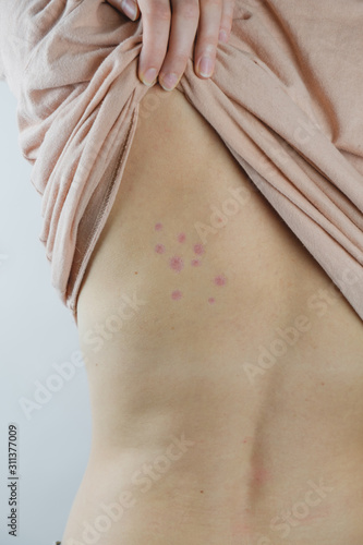 Damaged skin on female's back. Bedbug bites, moosquito bites or skin disease on human body, vertical shot photo