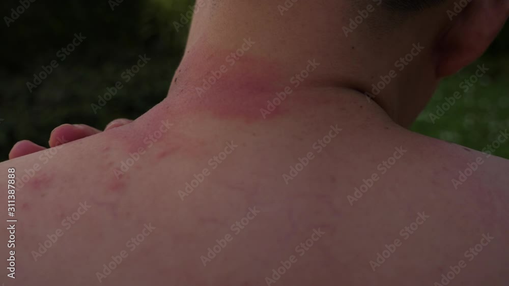Handsome man get allergy of something that make his skin get swelled up, red rash, itchy. Asian guy get venoms of animals or Paederus dermatitis, Rove beetles bite him. He has a burning pain at skin Handsome man get allergy of something that make his skin get swelled up, red rash, itchy. Asian guy get venoms of animals or Paederus dermatitis, Rove beetles bite him. He has a burning pain at skin