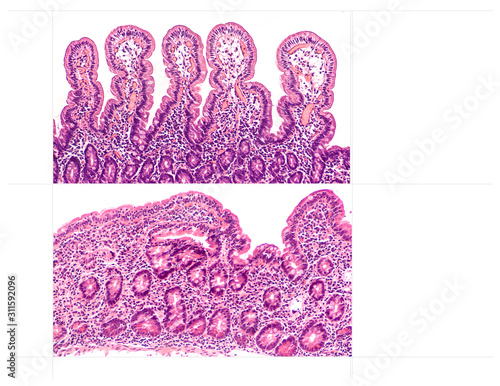 Celiac disease (sprue, gluten sensitive enteropathy) is an autoimmune disorder of the small intestine with diarrhea, bloating. Normal long villi (above) vs celiac disease (below) with blunted villi.  photo