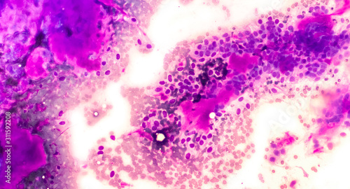 Fine needle aspiration (FNA) cytology of a benign mixed tumor of the salivary gland (pleomorphic adenoma).