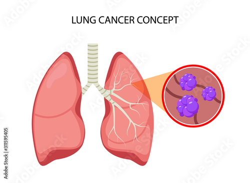 Lung cancer vector concept repiratory disease. Cartoon human lung cancer icon