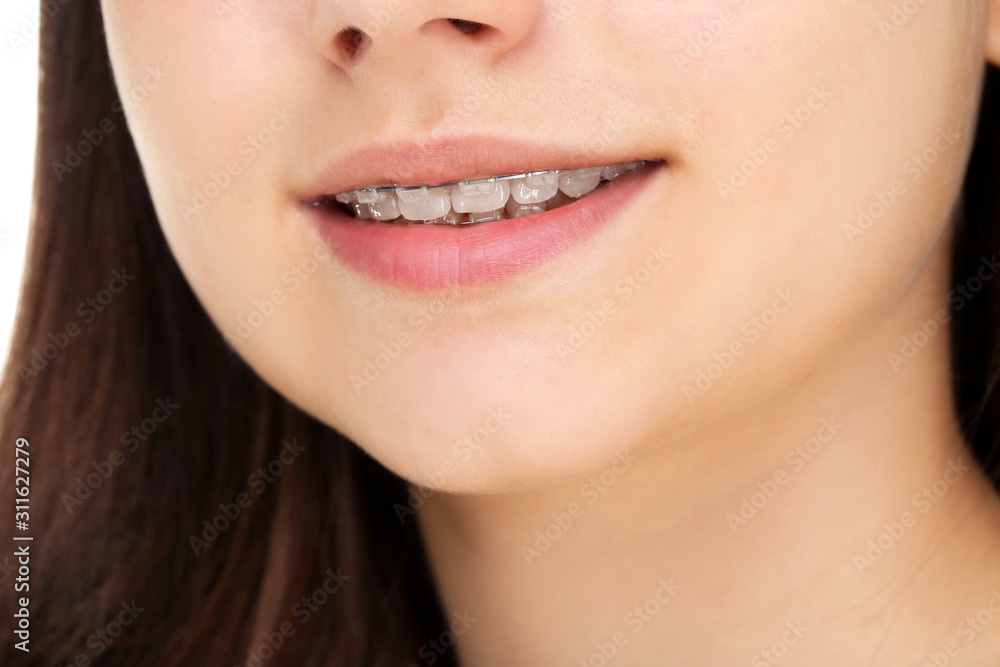 Young girl with dental braces Young girl with dental braces