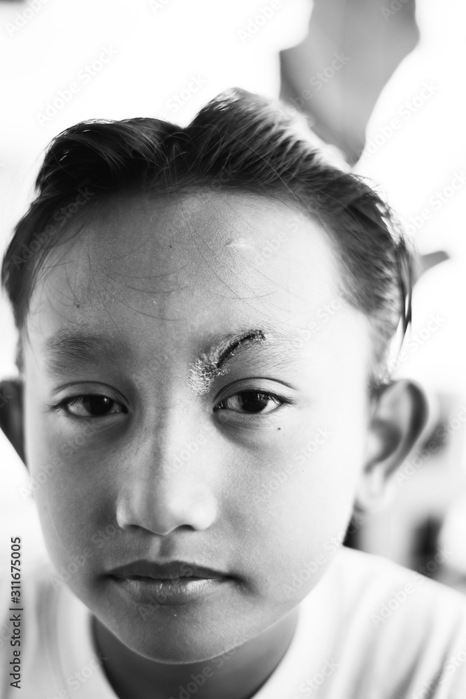 Healed minor cut wound after the surgical glue stiches. Scar at left eyebrow of Southeast Asian, Malaysian little boy with double eyelid. Health concept. Healed minor cut wound after the surgical glue stiches. Scar at left eyebrow of Southeast Asian, Malaysian little boy with double eyelid. Health concept.