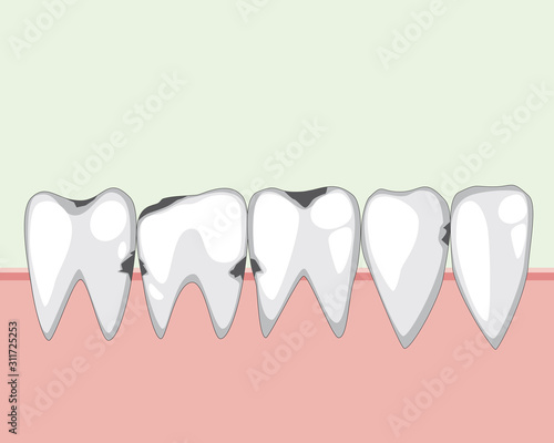 A caries on teeth with incisors and molars with gums, a vector stock illustration with adult tooth to the dental clinic as a concept of sick molars