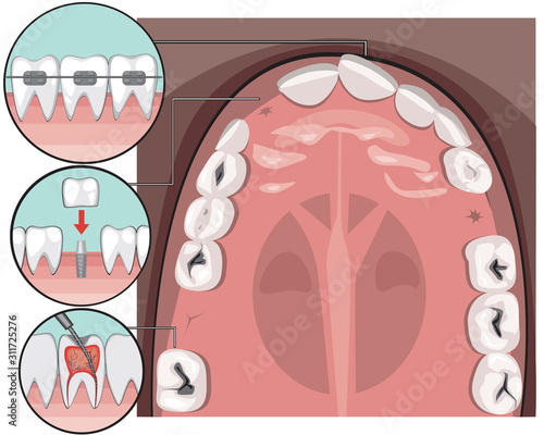 A top view of molars and incisors on the jaw caries before visiting the dentist or orthodontist, A vector stock illustration with braces on teeth, pulpitis and dental implant