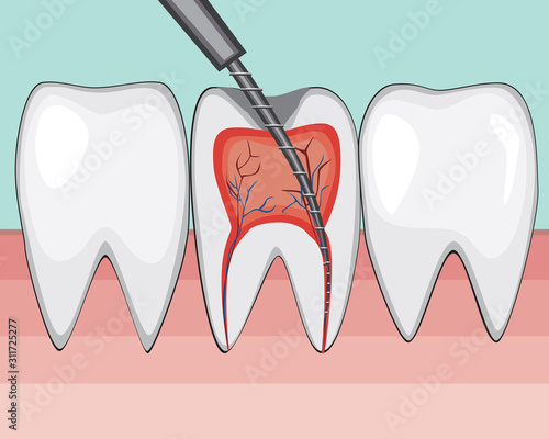 A treatment of molar pulpitis in a dental or orthodontic clinic by a doctor, a flat vector stock illustration with open tooth channel, boron machine and nerves as a concept of dental treatment