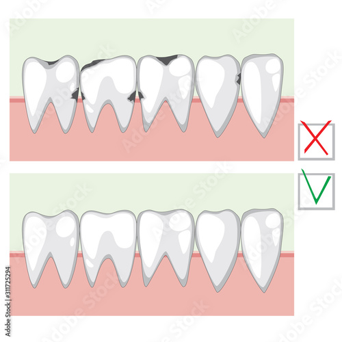A Caries and healthy teeth before and after visiting an orthodontist or dentist, a vector stock illustration with infographics for dental clinic