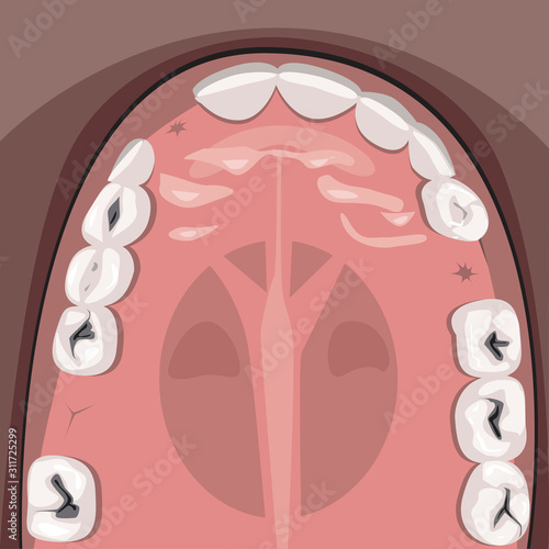 A caries and jaw of an adult with molars top view before visiting the dental clinic, a vector stock illustration with teeth and incisors as a concept of tooth pain