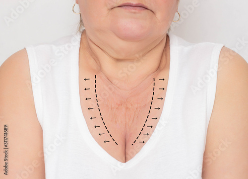 Woman with problem skin in the decollete area on a white background. The concept of plastic surgery in medicine, skin tightening on the neck and decollete , markers