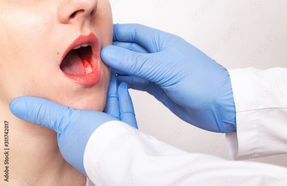 Dentist doctor examines the bite of the jaw of a girl and a bad tooth with pulpitis, gum disease, close-up, fluorosis - obrazy, fototapety, plakaty 