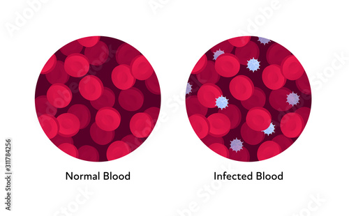 Microbiology medicine concept. Vector flat illustration. Normal and virus infected blood isolated on white. Design element for banner, poster, background, web, healthcare infographic.