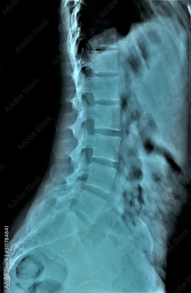 x ray of lumbar and sacral spine in lateral projection, medical ...