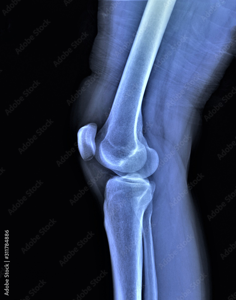 Obraz premium x ray of the knee joint , medical diagnostics, traumatology and orthopedics