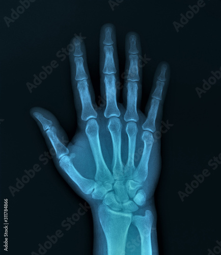 x-ray of hand bones, diagnosis of diseases © Anton