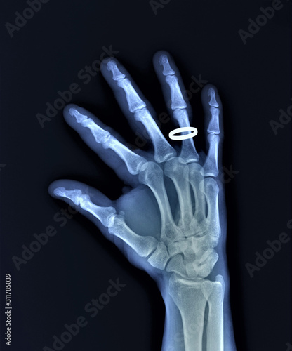 x-ray of the right hand with a wedding ring