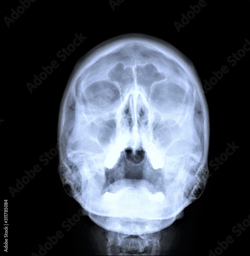 normal radiography of the paranasal sinuses of the facial skull