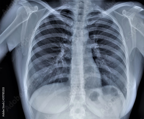 normal radiography of chest organs in direct projection, traumatology and orthopedics, pulmonology