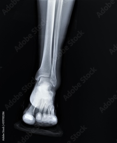 x-ray of the ankle joint in direct projection © Anton