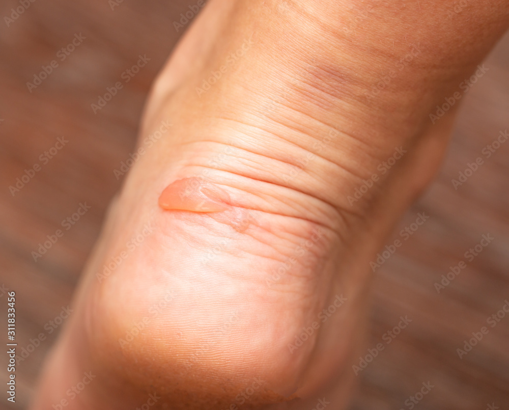 grated blown callus on the foot on the skin grated blown callus on the foot on the skin