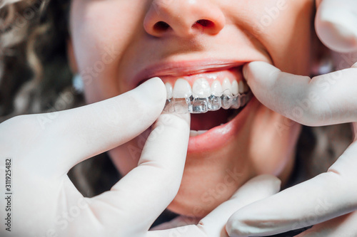 Doctor putting a clear dental aligner to the patient woman photo
