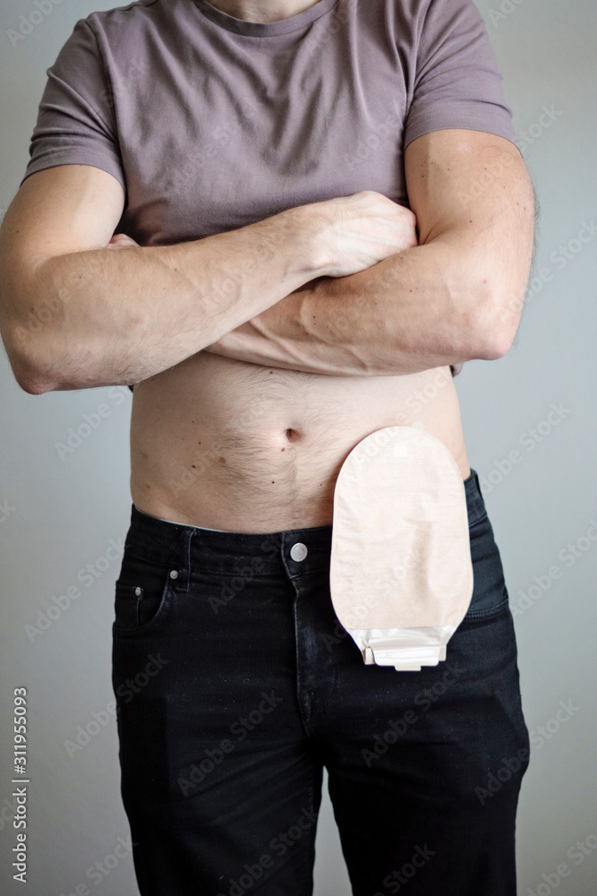 174 Colostomy Care Stock Photos - Free & Royalty-Free Stock Photos from  Dreamstime