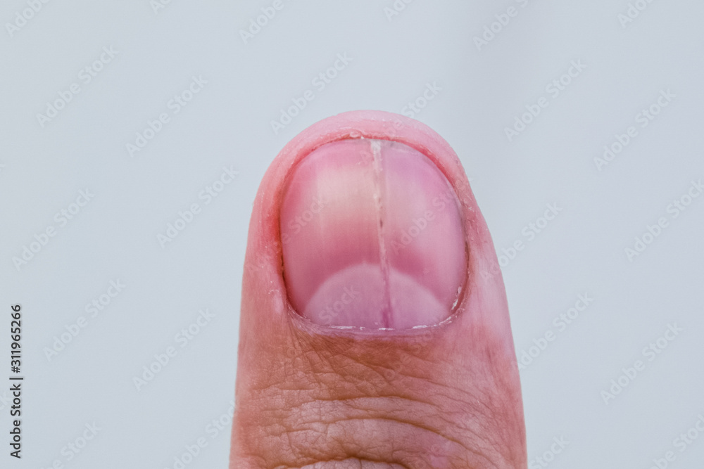 Forked nail on the thumb. Dilation of the nail, traumatic pathol Forked nail on the thumb. Dilation of the nail, traumatic pathol