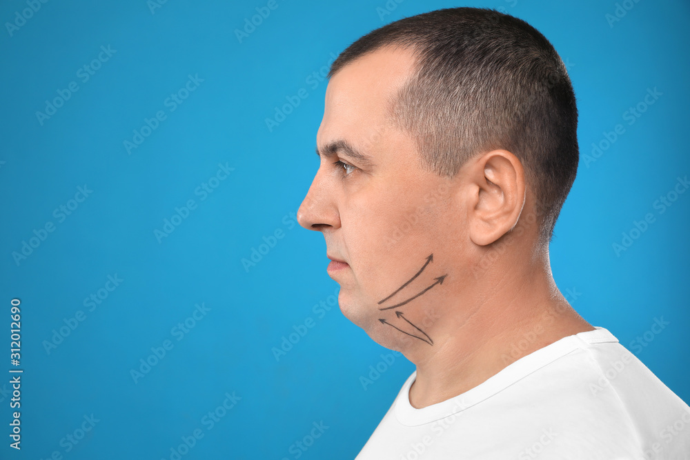 Fototapeta premium Mature man with marks on face against blue background, space for text. Double chin removal