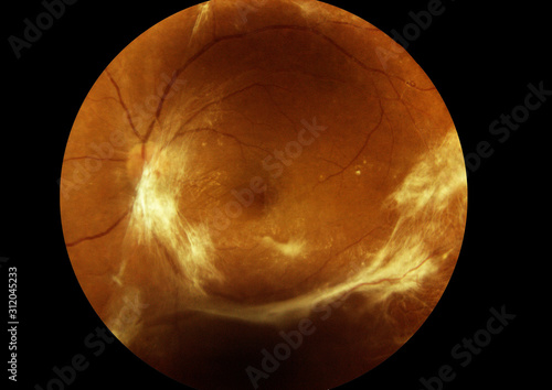 Retinal image in diabetic patients There are many white fibers . photo