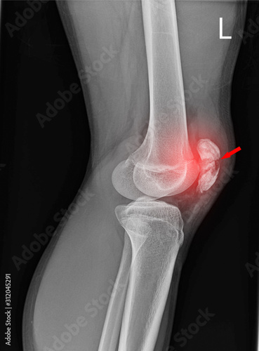 Photography Knee joint x-ray fracture kneecap.