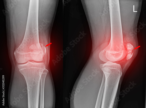 Knee joint x-ray fracture patella. photo