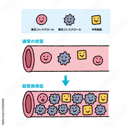コレステロール　中性脂肪　善玉　悪玉　動脈硬化　イラスト