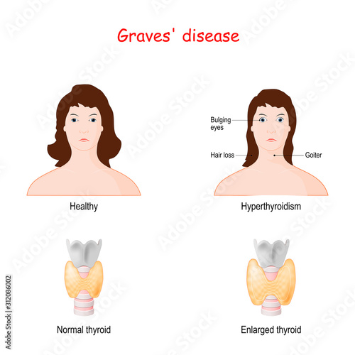 Graves disease. toxic diffuse goiter.