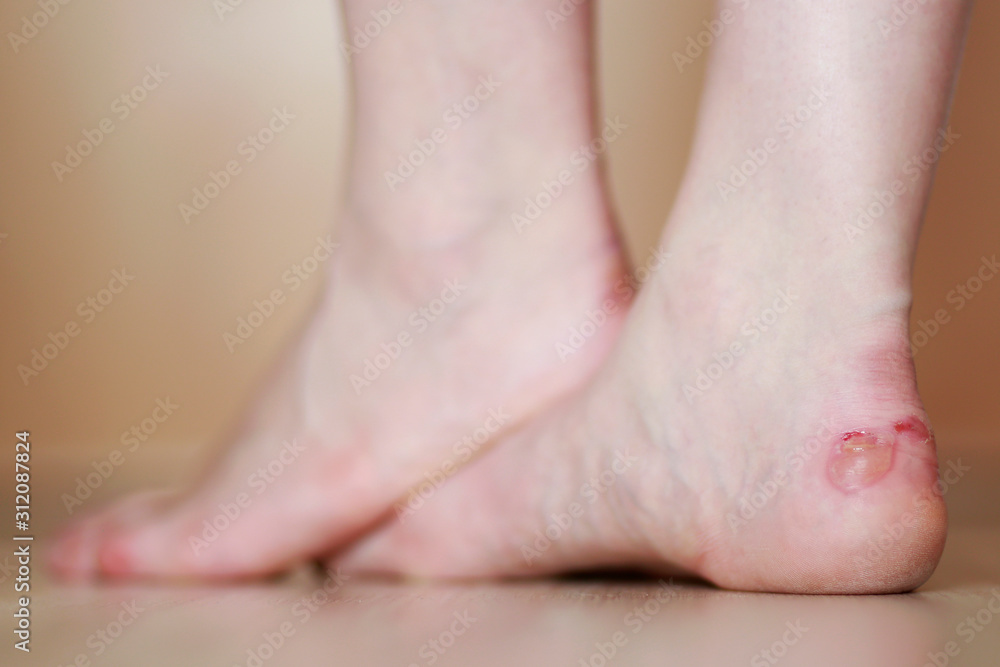 Woman's feet with blister close up. Injured foot from high heels.  - obrazy, fototapety, plakaty 