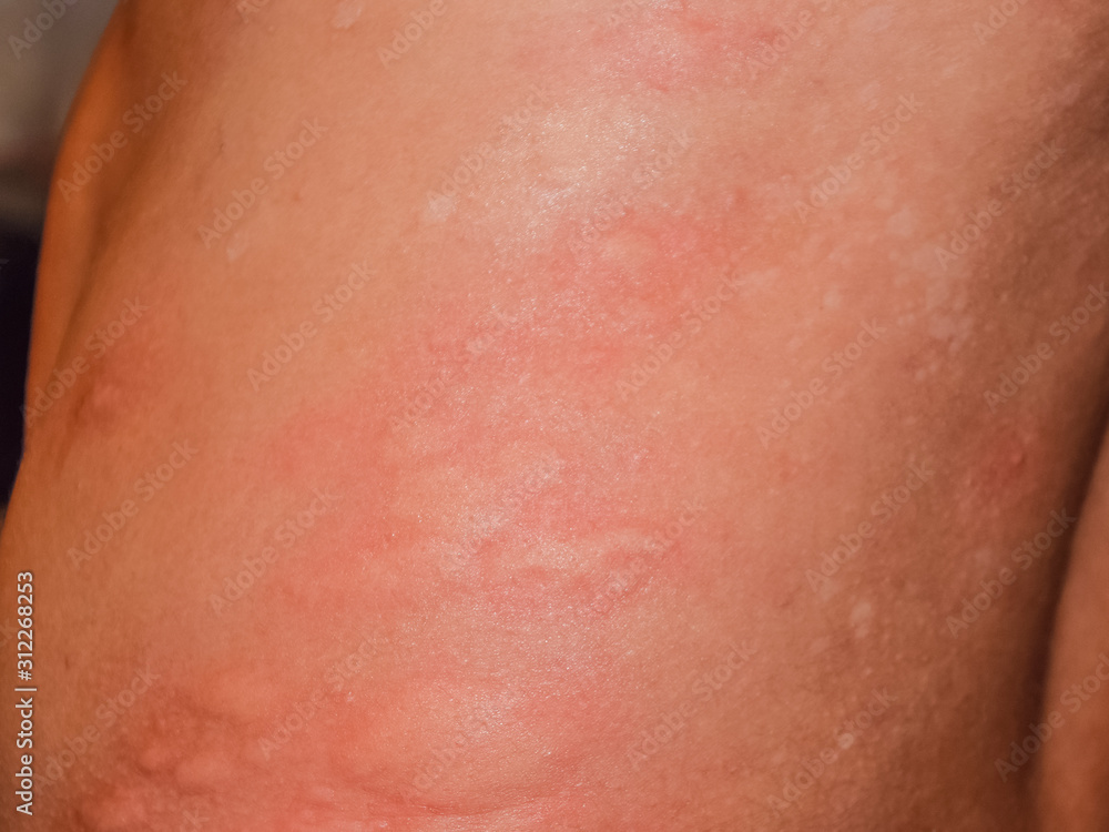 Allergy skin back and sides. Allergic reactions on the skin in the form of swelling and redness Allergy skin back and sides. Allergic reactions on the skin in the form of swelling and redness