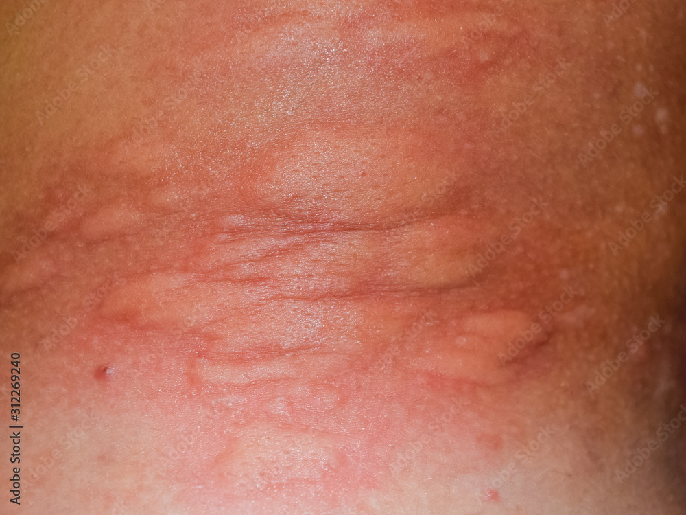 Allergy skin back and sides. Allergic reactions on the skin in the form of swelling and redness