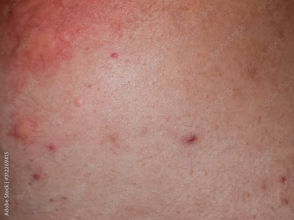 Allergy skin back and sides. Allergic reactions on the skin in the form of swelling and redness