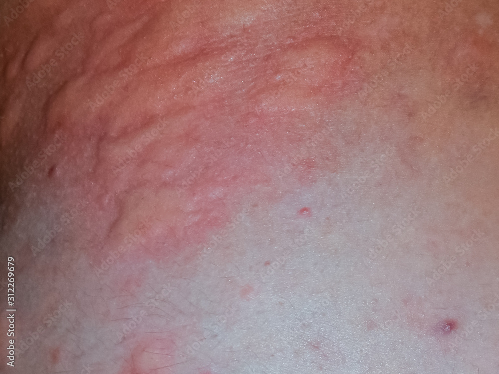 Fototapeta premium Allergy skin back and sides. Allergic reactions on the skin in the form of swelling and redness