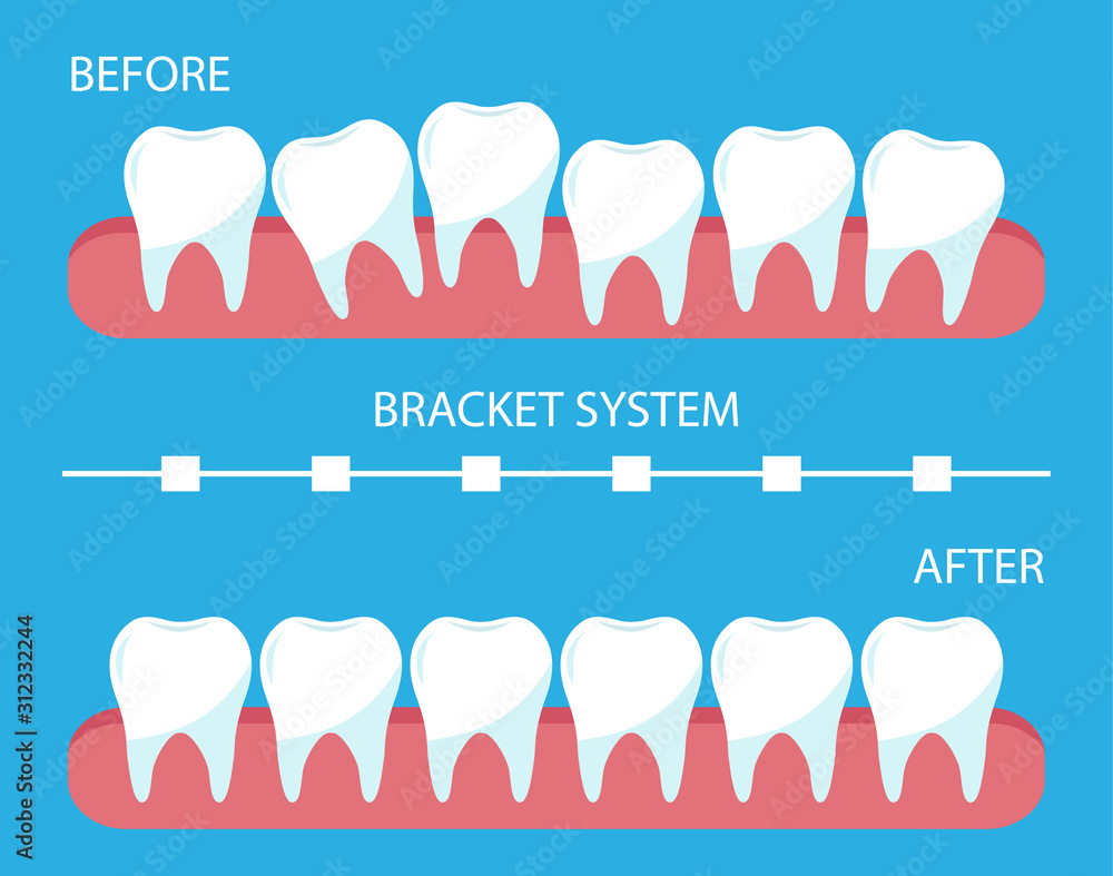 The process of correction of teeth with orthopedic braces. Stages of