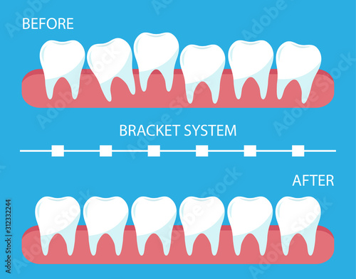 The process of correction of teeth with orthopedic braces. Stages of teeth alignment, before and after correction. Poster bracket system, flat style