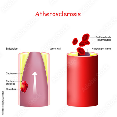 Cholesterol. Thrombus formation in an atherosclerotic vessel